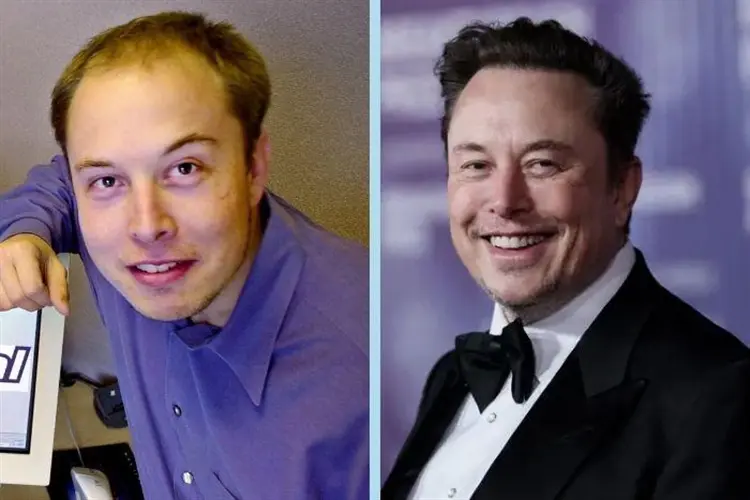 Did Elon Musk Get a Hair Transplant? Before & After Photo Analysis