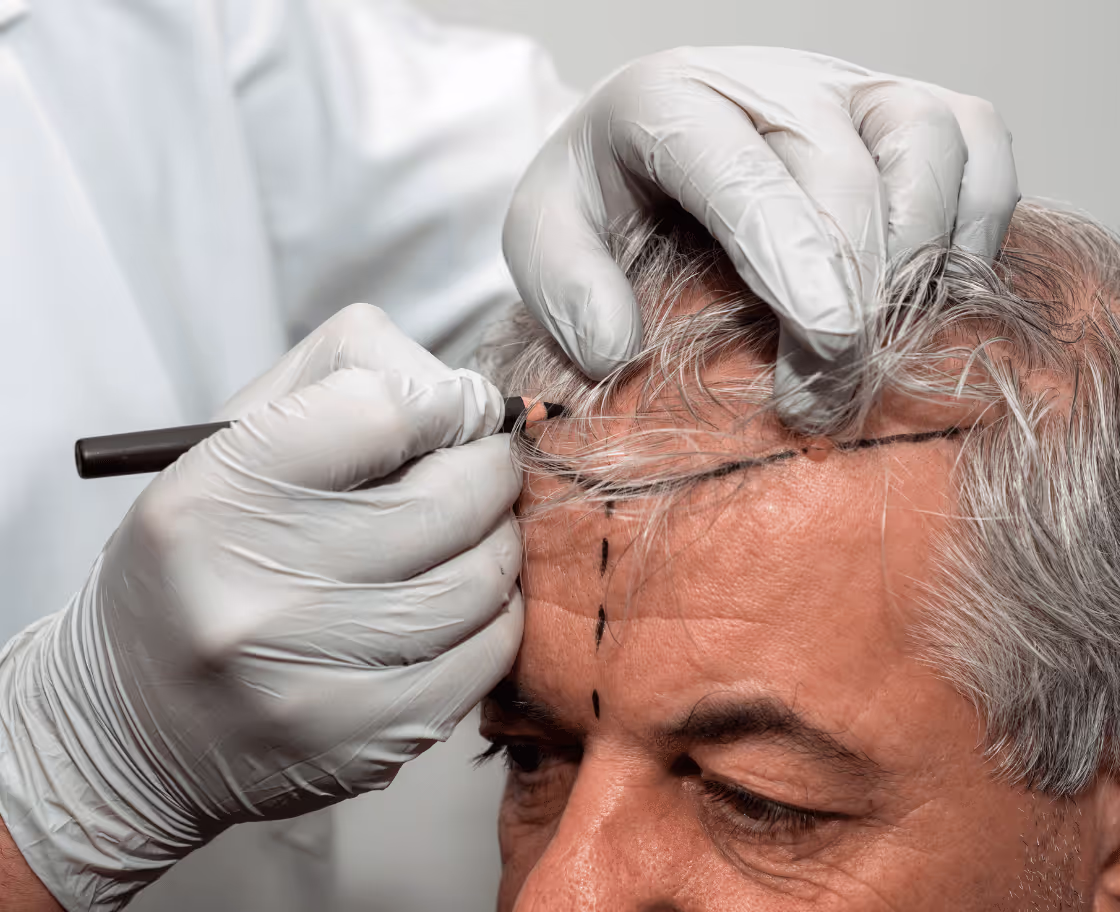 DHI Saç Ekimi Ameliyatı Nasıl Yapılır?