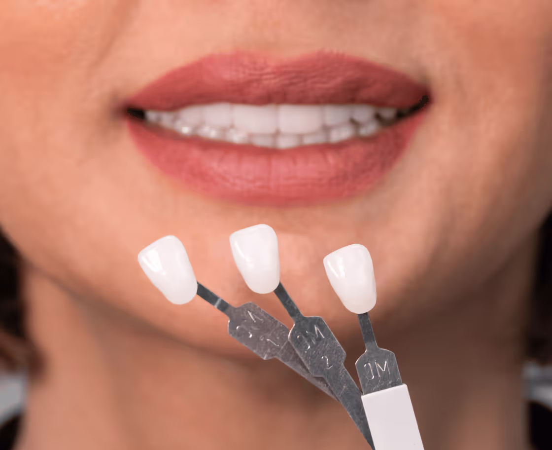 Expected Results & Benefits of Zirconium Tooth Veneers