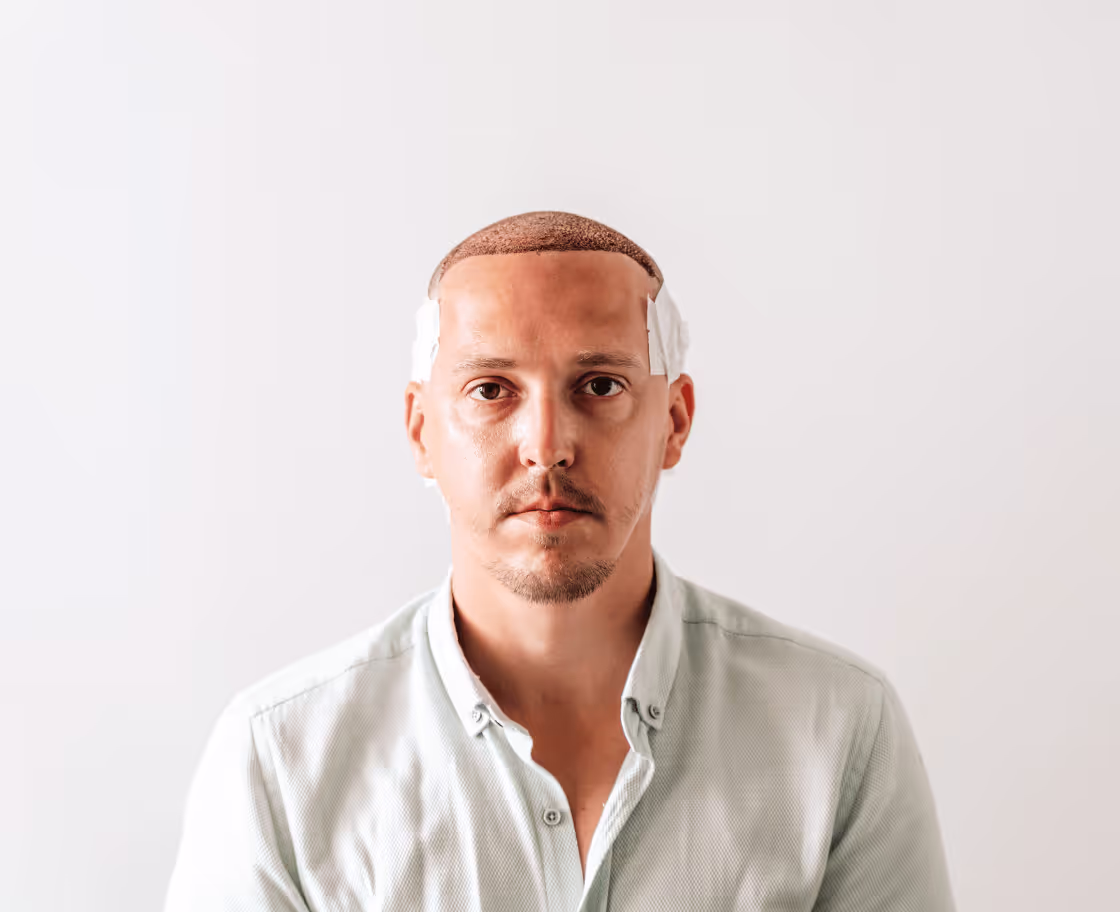 FUE Saç Ekimi Beklenen Sonuçlar ve Faydaları