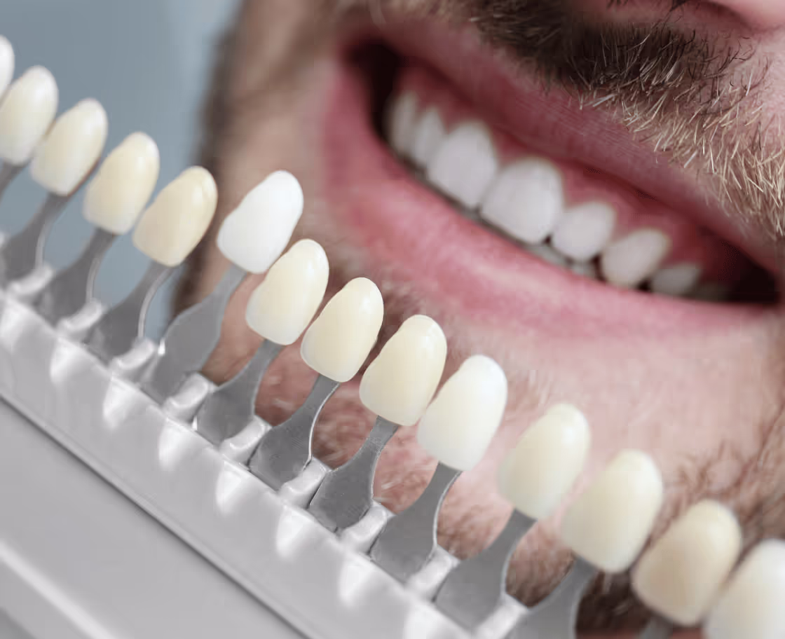 How Do Zirconium Tooth Veneers Work?