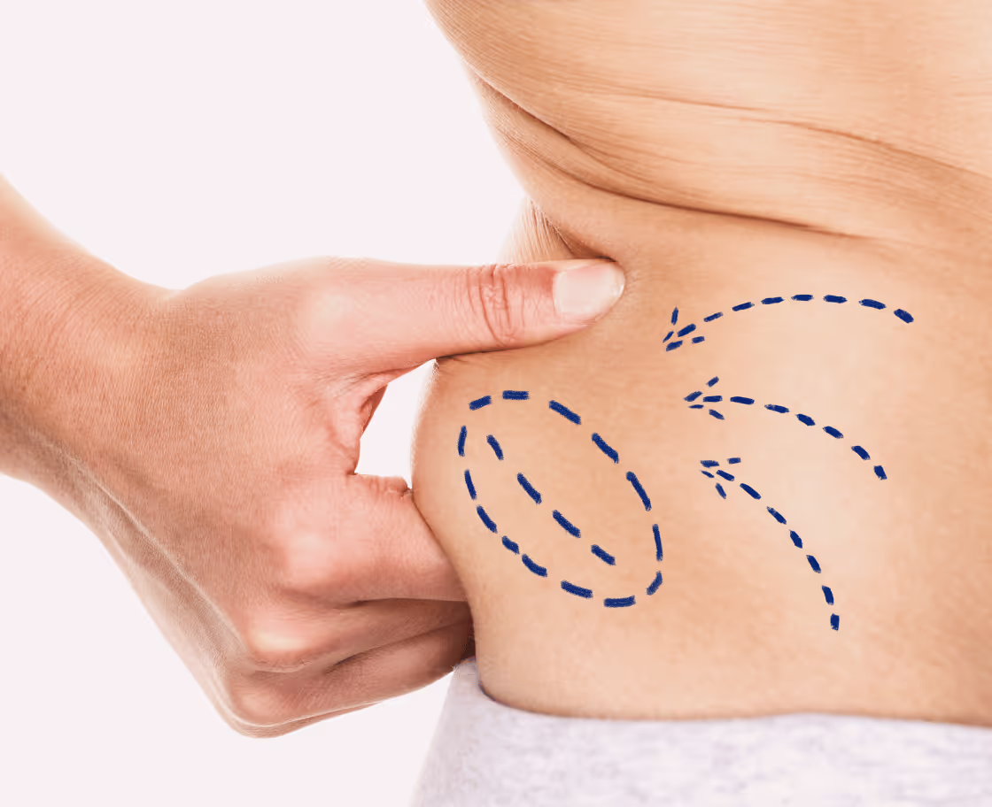 Liposuction'ın Beklenen Sonuçları ve Faydaları