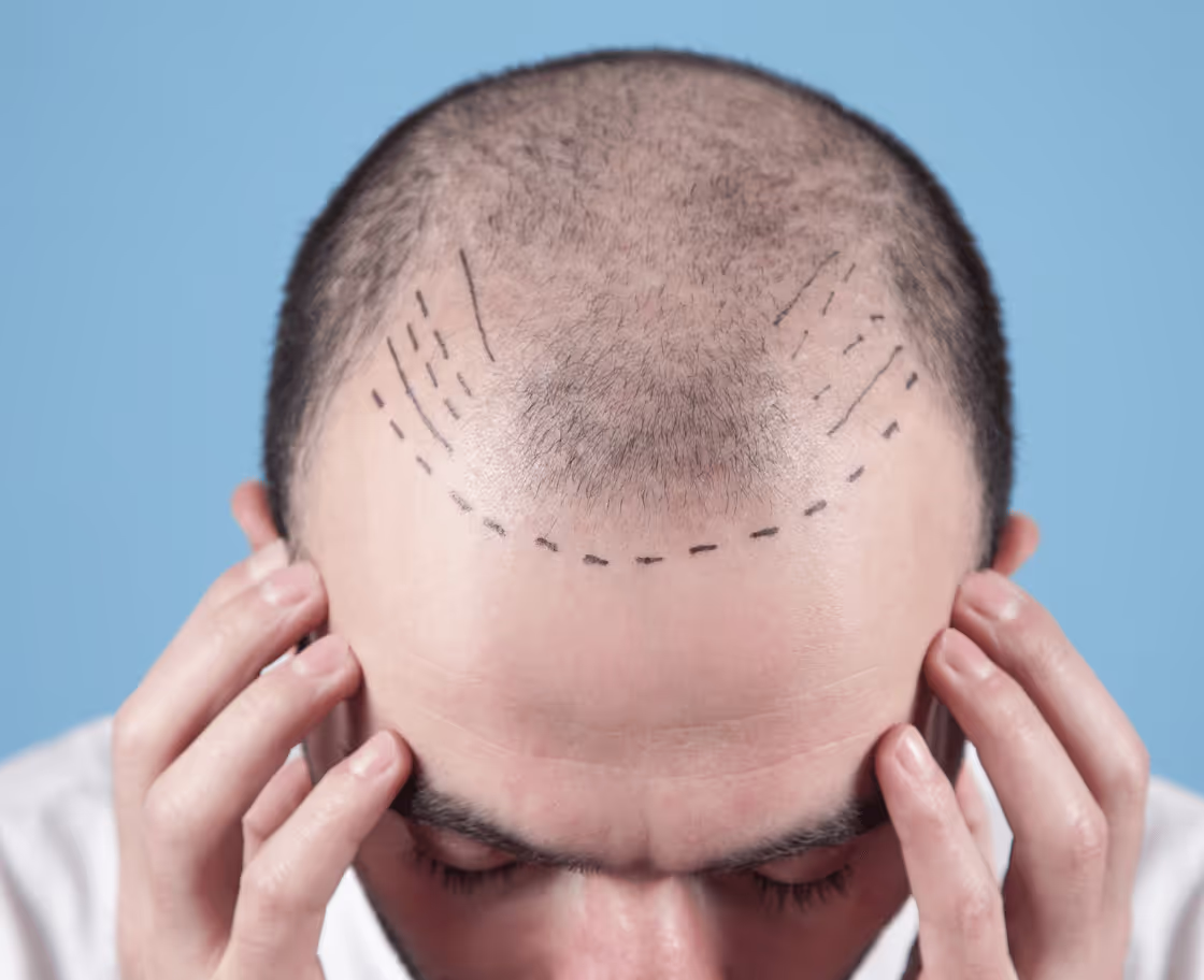 Was ist eine Haartransplantation?