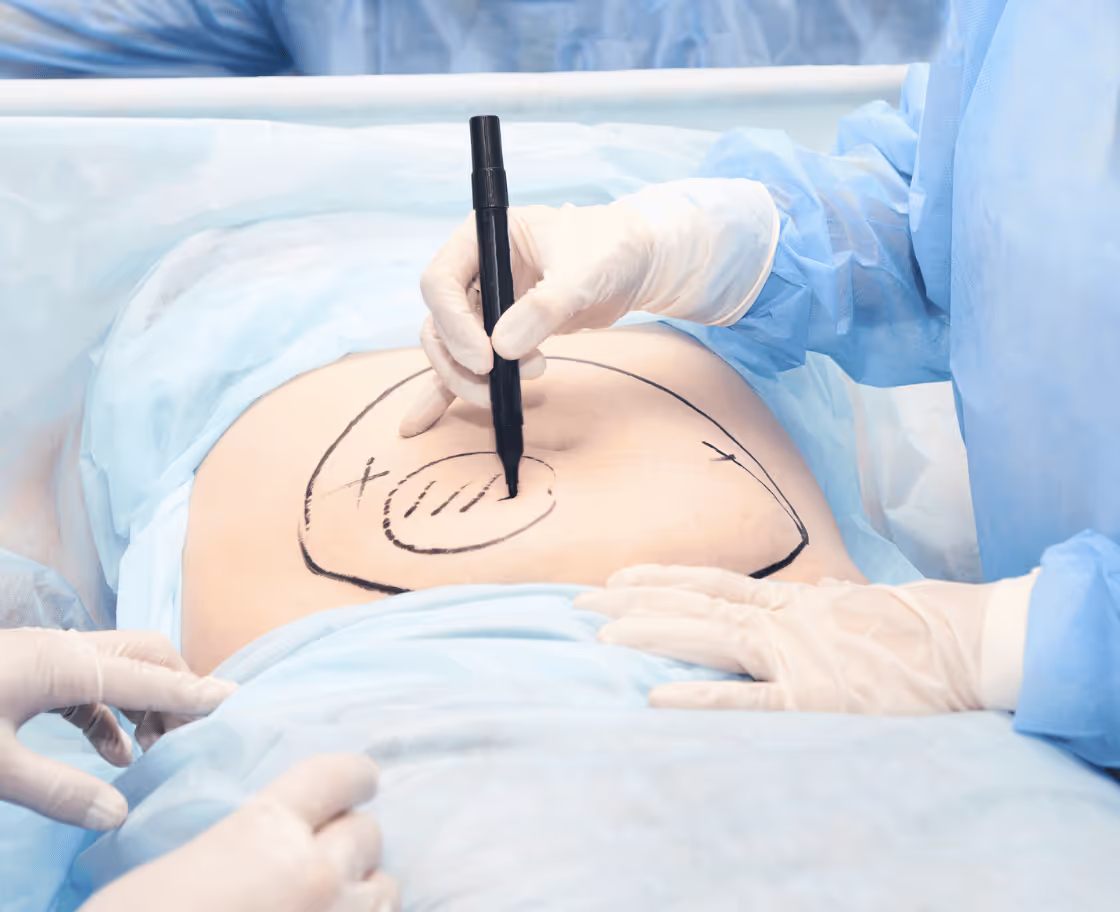 Wer kann von einer Fettabsaugung profitieren?