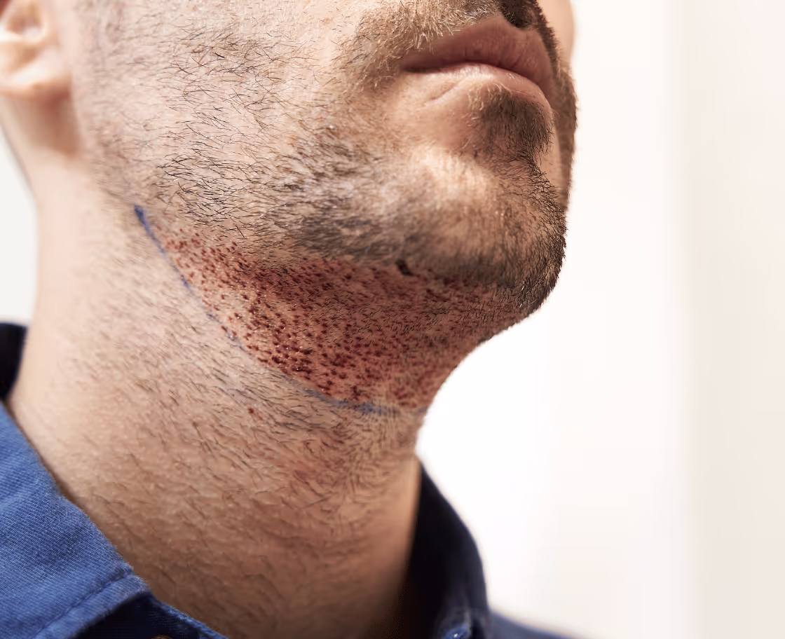 What Is Beard Transplant Surgery?