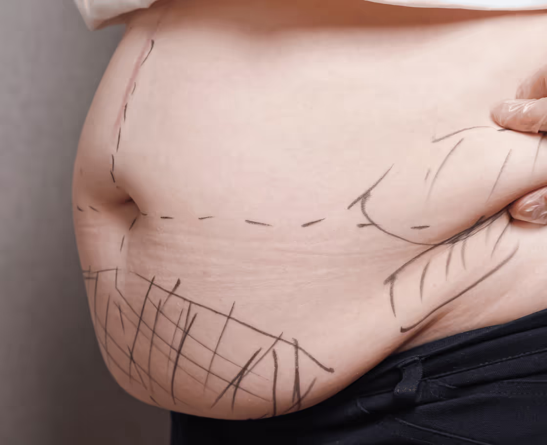 What Is Liposuction?