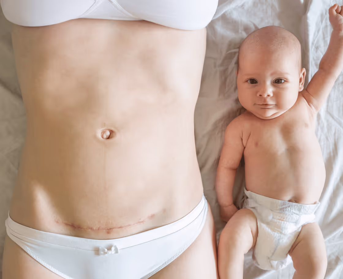 What Is Mommy Makeover?