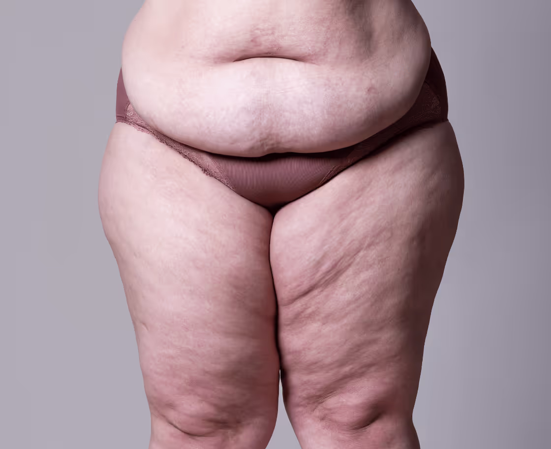 What Is Thigh Lift Surgery?