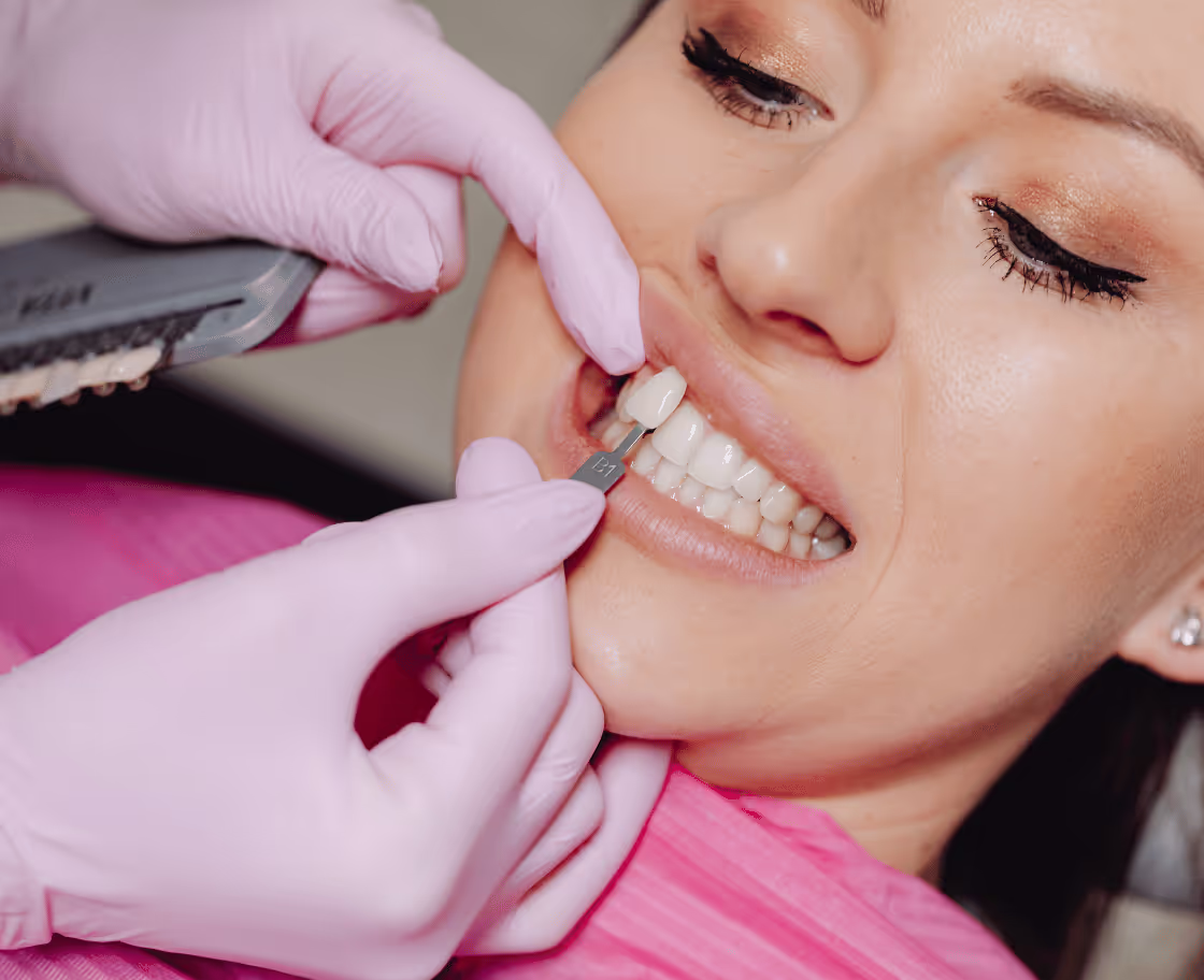 What Is Zirconium Tooth Veneers?
