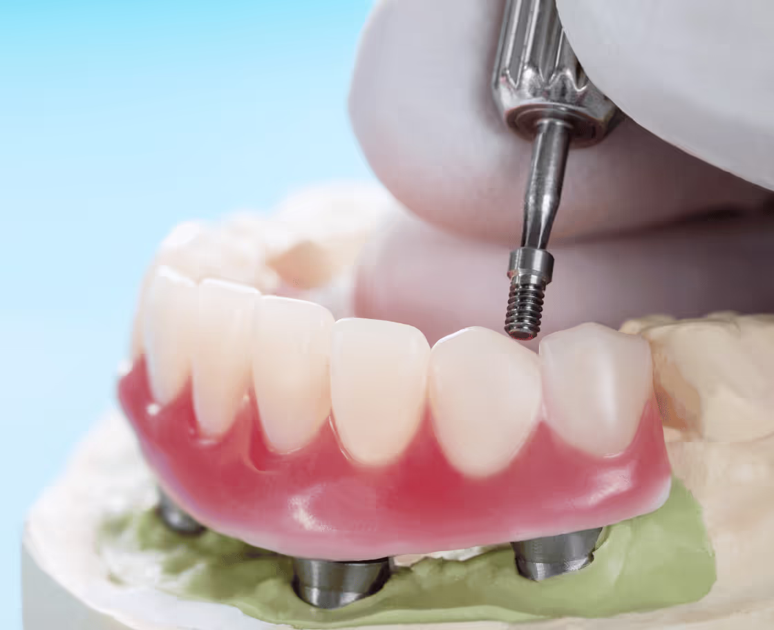 Who Can Benefit from All on 4 Dental Implants Surgery?