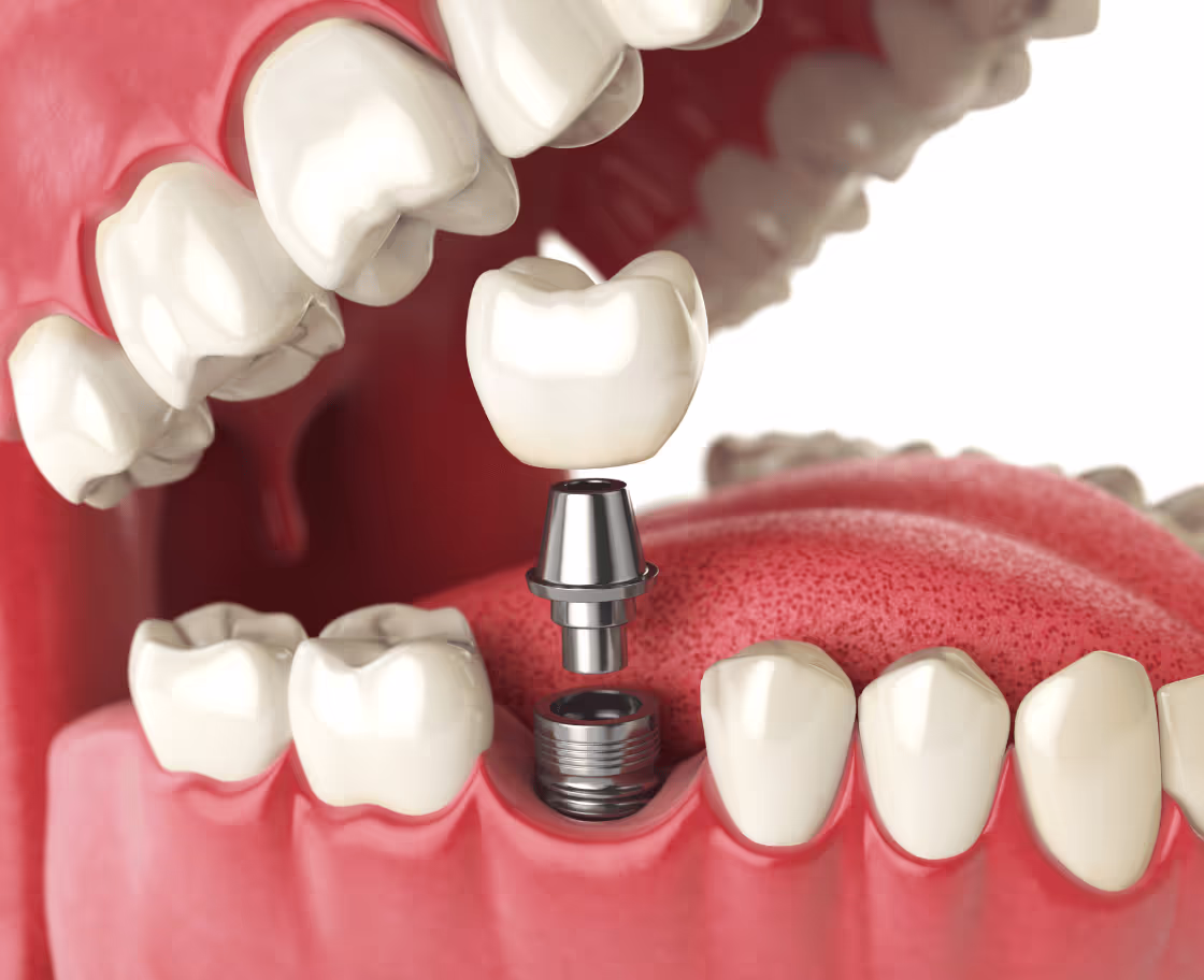 Who Can Benefit from Dental Implant Surgery?