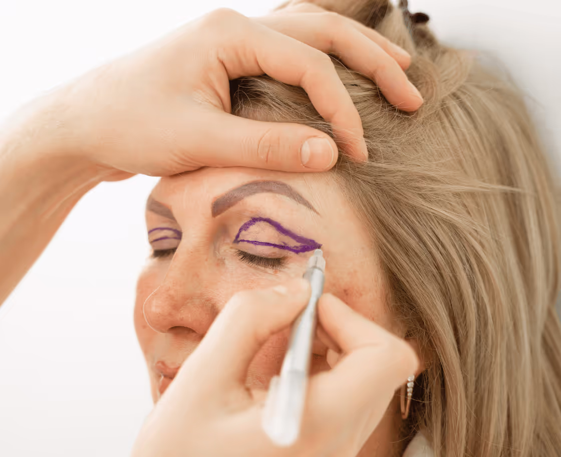 Wie läuft eine Augenlidoperation (Blepharoplastik) ab?