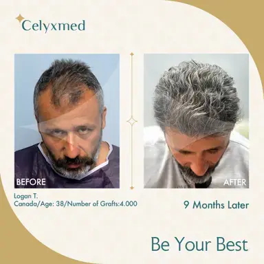 DHI Hair Transplant in Turkey