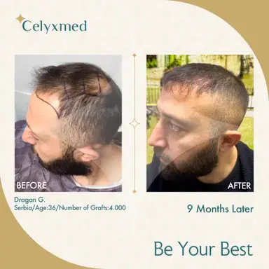 FUE Hair Transplant in Turkey