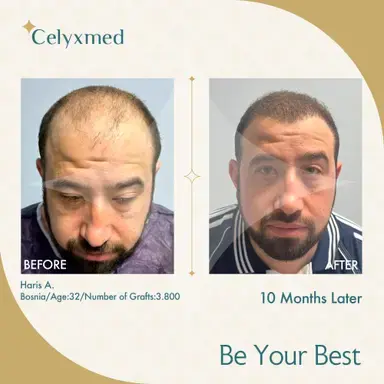 FUE Hair Transplant in Turkey
