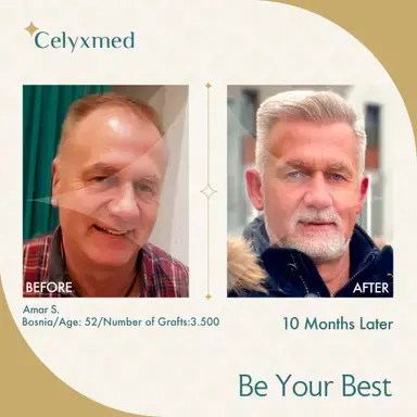 Türkiye'de FUE Saç Ekimi