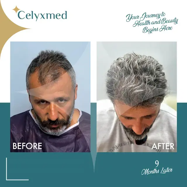 Hair Transplant in Turkey