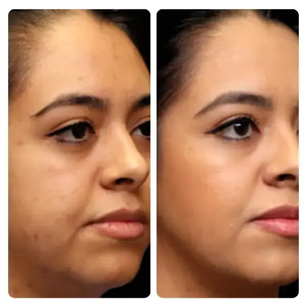 Türkiye'de yüz germe ameliyatı