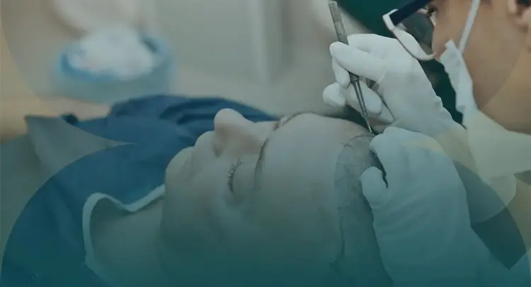 Hair Transplant in Turkey